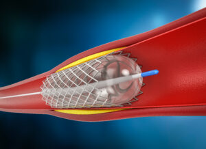 Coronary Angiography​