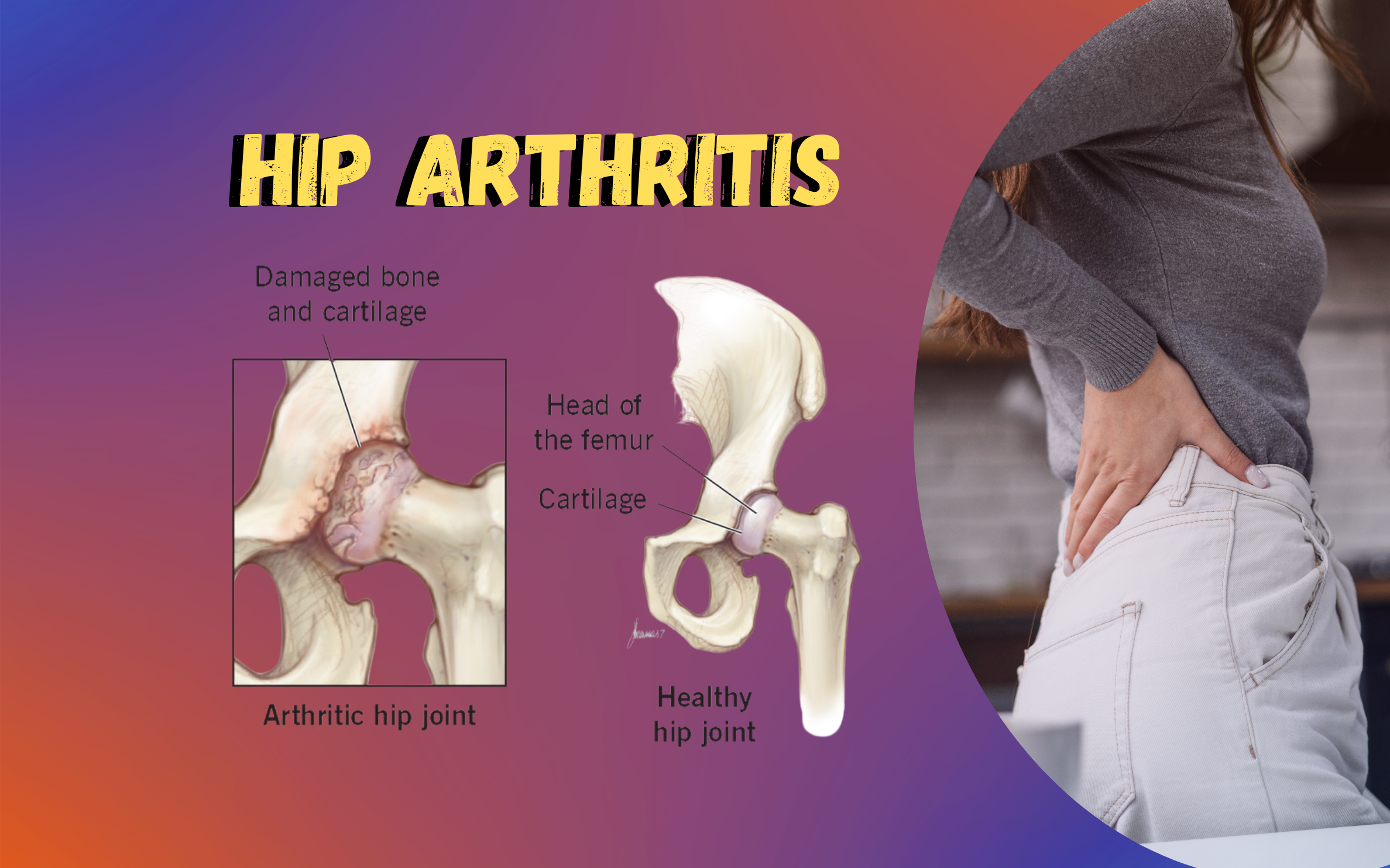 Hip Arthritis Symptoms: A Complete Patient-Focused Guide from MGM Medical Centre