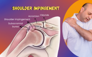 Shoulder Impingement Causes: When to Visit an Orthopedic Hospital in Hyderabad