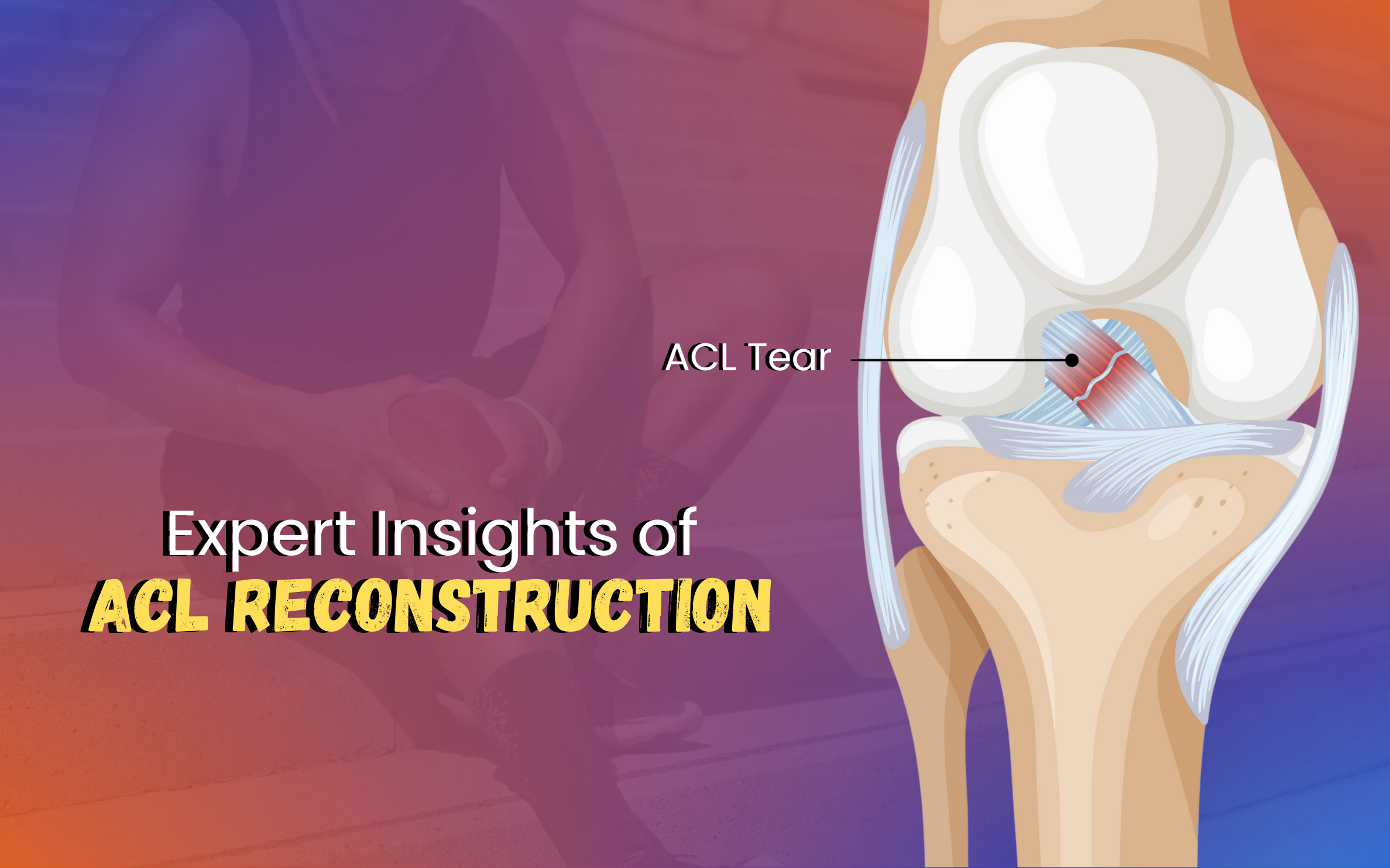 ACL Reconstruction: Expert Insights for Patients and Athletes
