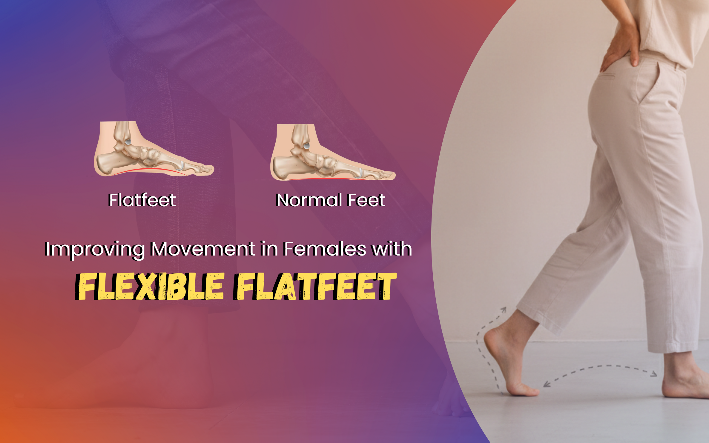 Improving Movement in Females with Flexible Flatfeet